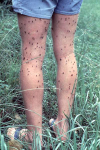 Mosquitos biting human legs
